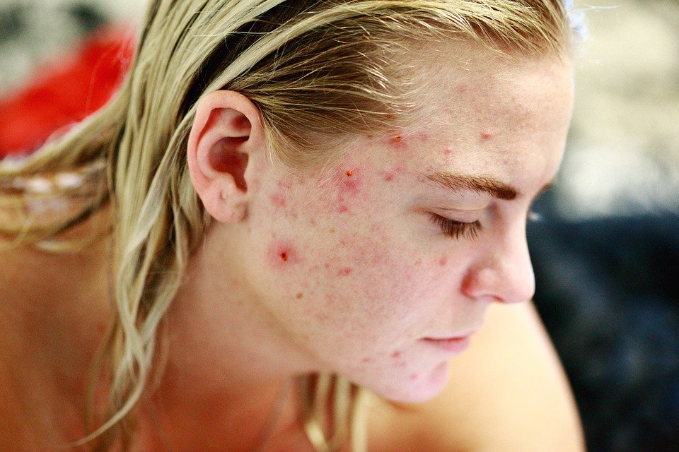 make acne sticky about the face